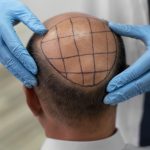 hair, hair care, hair transplant