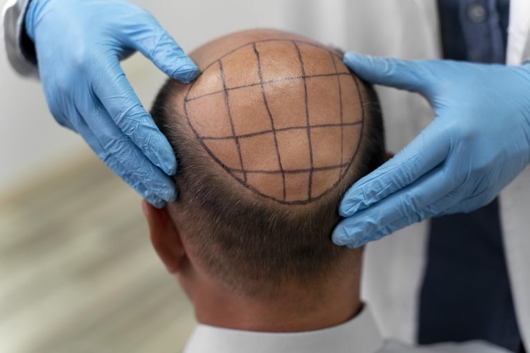 hair, hair care, hair transplant